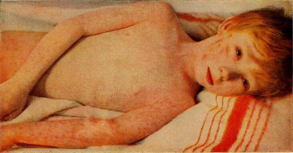 measles child Child with measles lying on his side