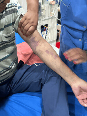 man with bruised arm Man’s arm covered in bruises