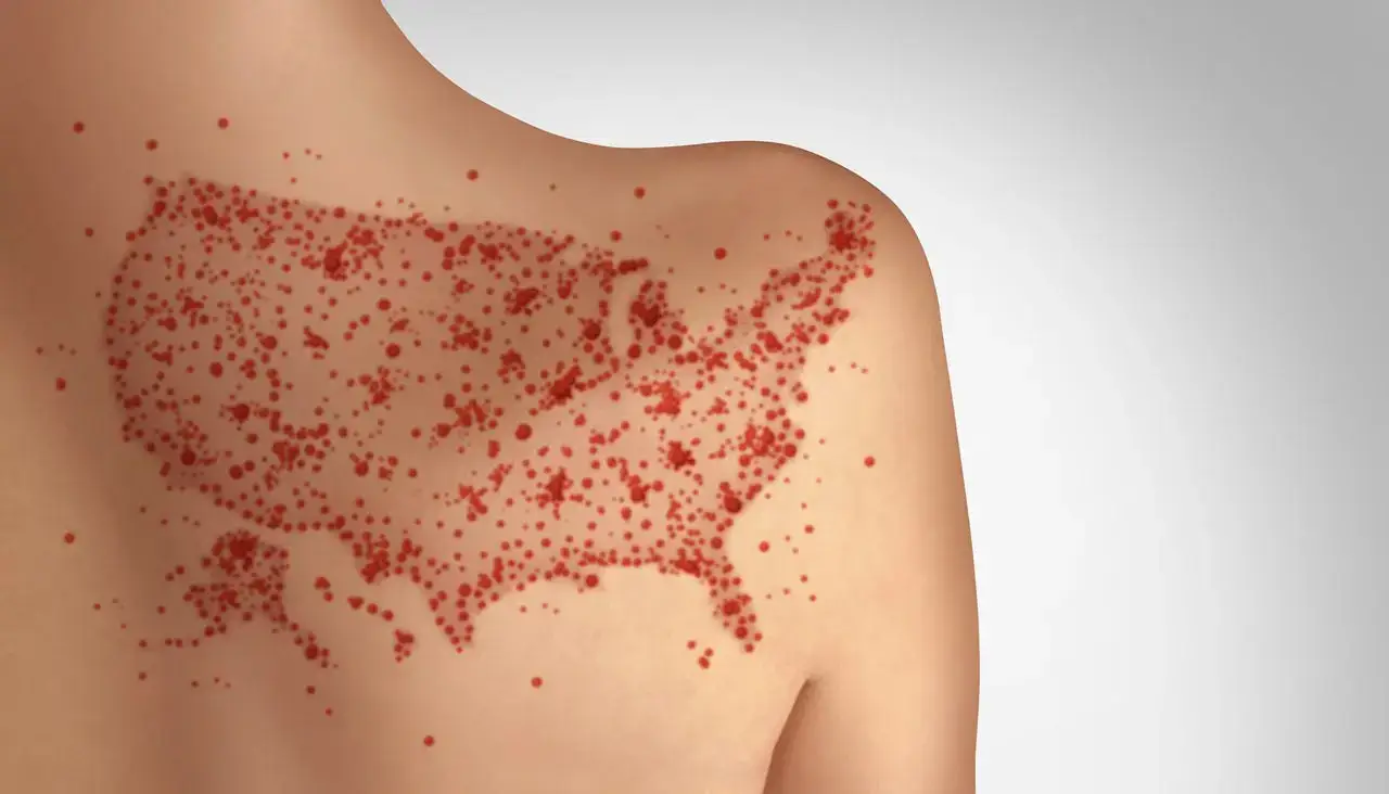 measles outbreaks us istock resized Measles outbreaks in the united states photo of a rash shaped like the us on a shoulder blade