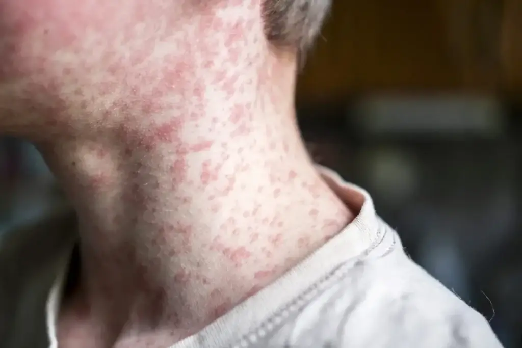 boy measles istock Measles rash on the boy’s neck measles outbreaks